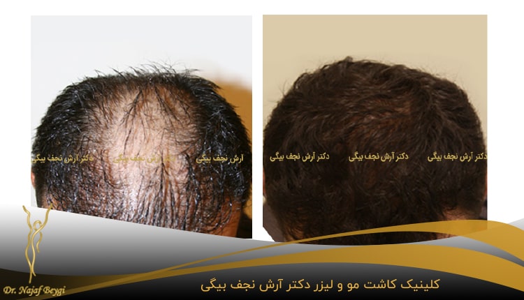 تشخیص بهترین روش کاشت مو