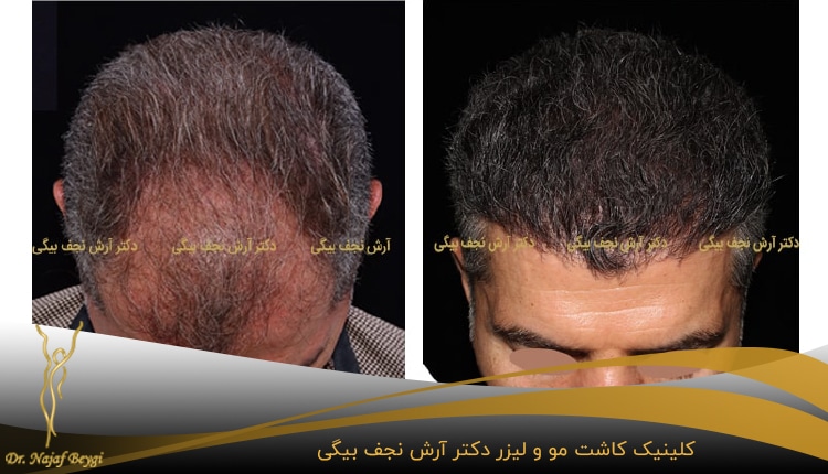 تغییرات کاشت موی سر