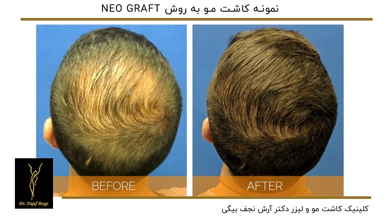نمونه کاشت مو به روش NEO GRAFT