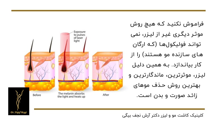 نحوه لیزر موهای زائد