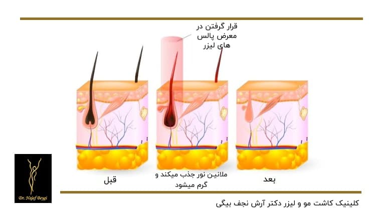 قبل و بعد از لیزر موهای زائد